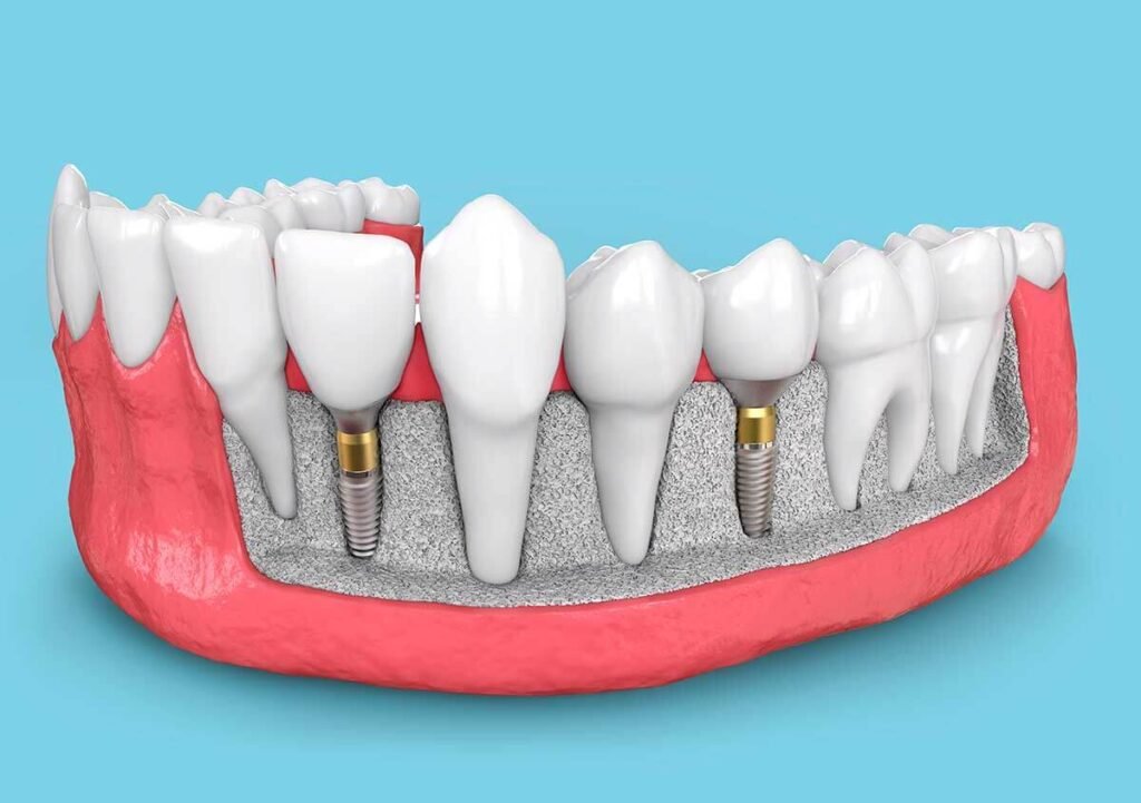 The Comprehensive Guide to Dental Implants in Manchester